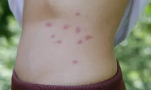 Haut eines Babys mit roten, juckenden Stichen, die auf Bettwanzenbefall hindeuten.
