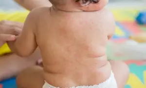 Roter Ausschlag auf dem Rücken eines Babys, deutet auf Fieber und Ausschlag bei Kindern hin.