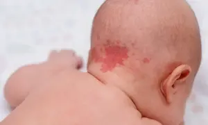 Ein roter Ausschlag im Nacken eines Babys, der wie ein Storchenbiss aussieht.