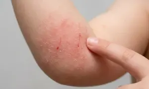 Roter Ausschlag an der Armbeuge ohne Jucken, mit leichten Kratzern und trockener Haut.