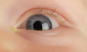 Nahaufnahme eines Babys mit einem verklebten Auge, das gelblichen Ausfluss zeigt.