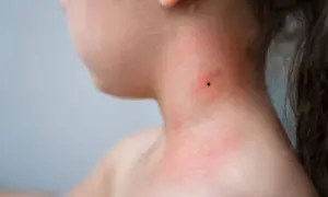 Zecke am Hals eines Kindes, gerötete Haut. Mögliche Borreliose Symptome bei Kindern früh erkennen.