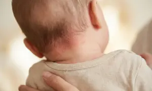 Rötungen und Schuppen am Nacken eines Babys, die auf trockene Kopfhaut hindeuten. Eltern suchen oft nach trockene kopfhaut hausmittel.