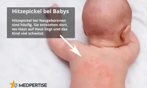 Rote Pusteln auf dem Rücken eines Babys, die auf Hitzepickel oder Sonnenallergie bei Kindern hindeuten.