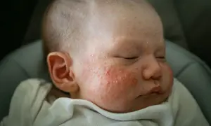 Schlafendes Baby mit geröteten Pusteln im Gesicht. Die Frage "babyakne wie lange" beschäftigt viele Eltern.
