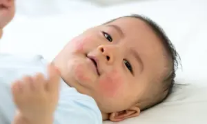 Ein Baby mit roten Flecken im Gesicht, die auf Nesselsucht bei Kindern hindeuten.
