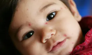Nahaufnahme eines Babys mit vielen kleinen roten Flecken im Gesicht, die auf Windpocken hindeuten.