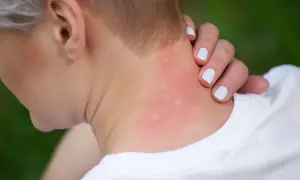 Rote, juckende Stellen am Hals deuten auf einen Insektenstich hin. Hausmittel können Linderung verschaffen.