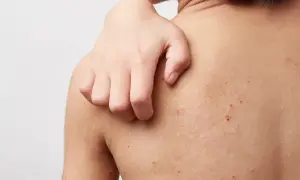 Kind kratzt sich am Rücken. Kleine rote Pusteln und helle Flecken deuten auf einen Hautausschlag bei Kindern hin.