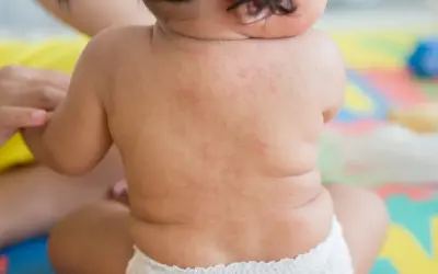 Roter Ausschlag auf dem Rücken eines Babys, deutet auf Fieber und Ausschlag bei Kindern hin.