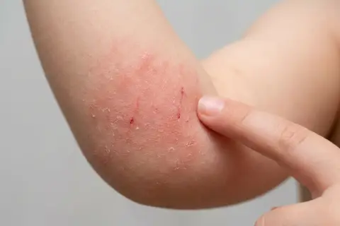 Roter Ausschlag an der Armbeuge ohne Jucken, mit leichten Kratzern und trockener Haut.