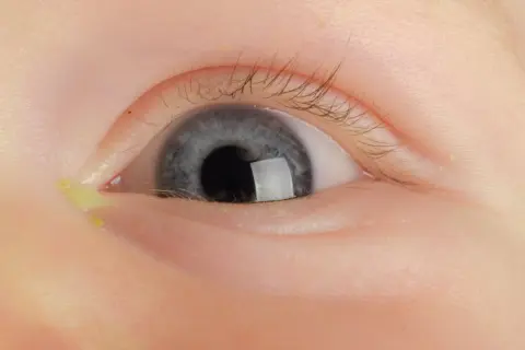 Nahaufnahme eines Babys mit einem verklebten Auge, das gelblichen Ausfluss zeigt.