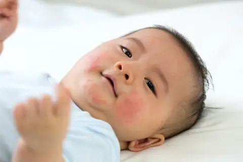 Ein Baby mit roten Flecken im Gesicht, die auf Nesselsucht bei Kindern hindeuten.