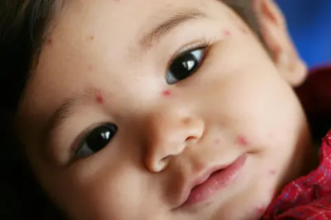 Nahaufnahme eines Babys mit vielen kleinen roten Flecken im Gesicht, die auf Windpocken hindeuten.