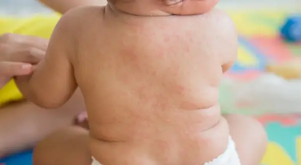 Roter Ausschlag auf dem Rücken eines Babys, deutet auf Fieber und Ausschlag bei Kindern hin.