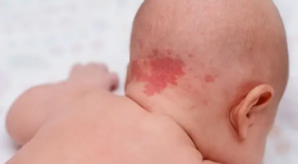 Ein roter Ausschlag im Nacken eines Babys, der wie ein Storchenbiss aussieht.