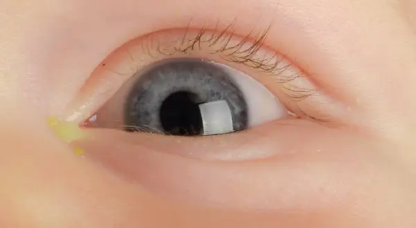 Nahaufnahme eines Babys mit einem verklebten Auge, das gelblichen Ausfluss zeigt.