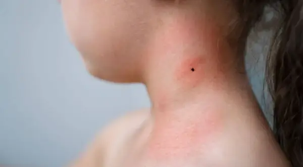 Zecke am Hals eines Kindes, gerötete Haut. Mögliche Borreliose Symptome bei Kindern früh erkennen.