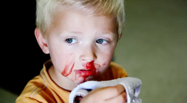 Junge mit blutiger Nase und einem Tuch. Ein häufiges Problem bei Kindern ist nasenbluten.
