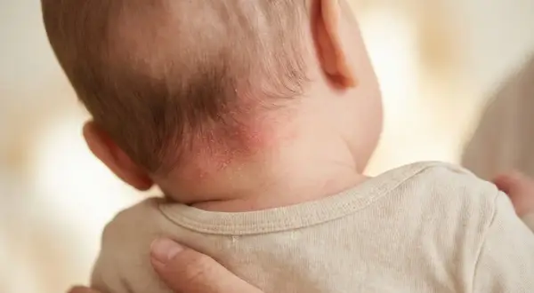 Rötungen und Schuppen am Nacken eines Babys, die auf trockene Kopfhaut hindeuten. Eltern suchen oft nach trockene kopfhaut hausmittel.