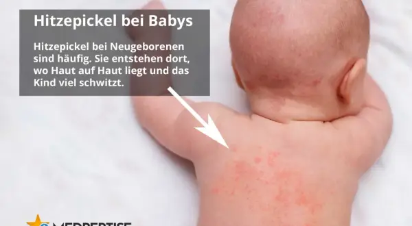 Rote Pusteln auf dem Rücken eines Babys, die auf Hitzepickel oder Sonnenallergie bei Kindern hindeuten.