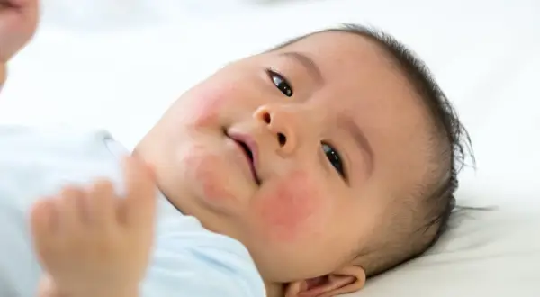 Ein Baby mit roten Flecken im Gesicht, die auf Nesselsucht bei Kindern hindeuten.