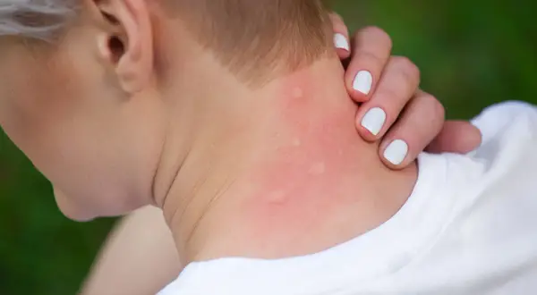 Rote, juckende Stellen am Hals deuten auf einen Insektenstich hin. Hausmittel können Linderung verschaffen.