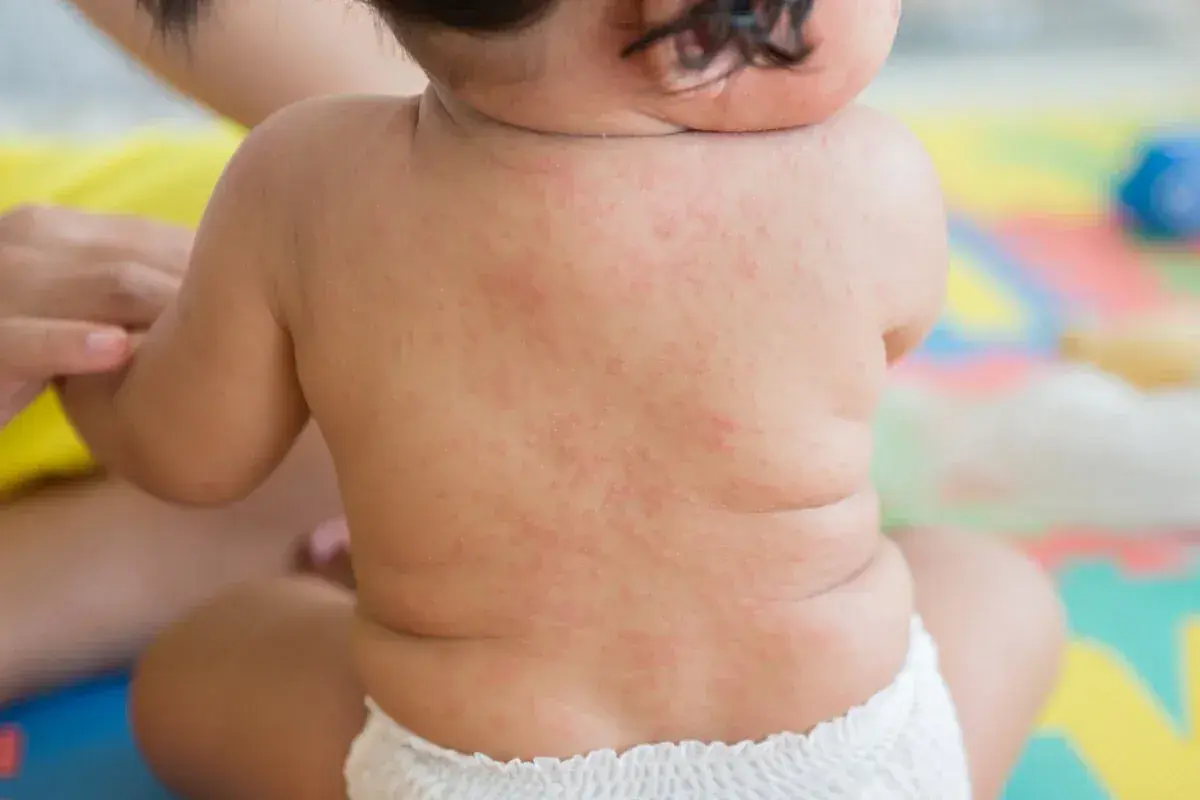 Roter Ausschlag auf dem Rücken eines Babys, deutet auf Fieber und Ausschlag bei Kindern hin.