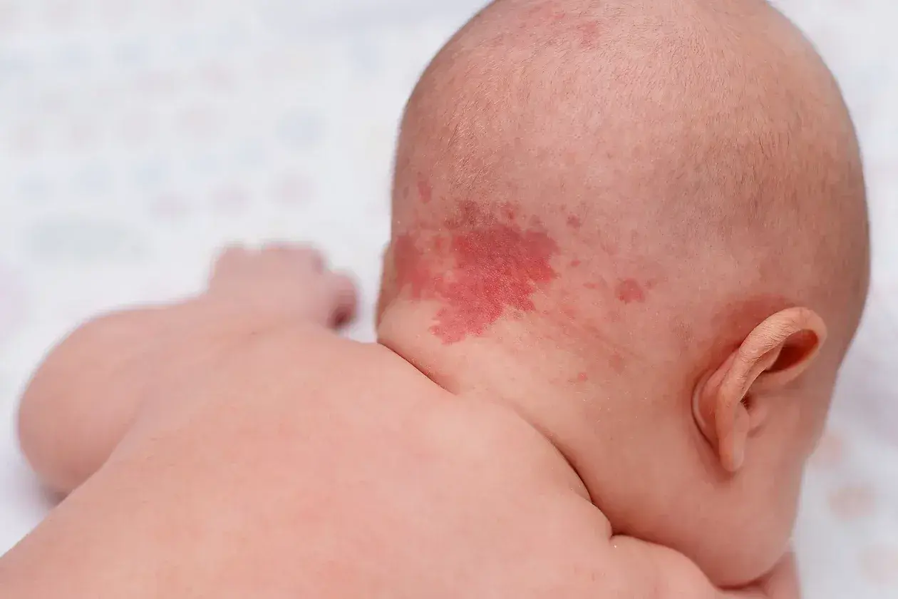 Ein roter Ausschlag im Nacken eines Babys, der wie ein Storchenbiss aussieht.