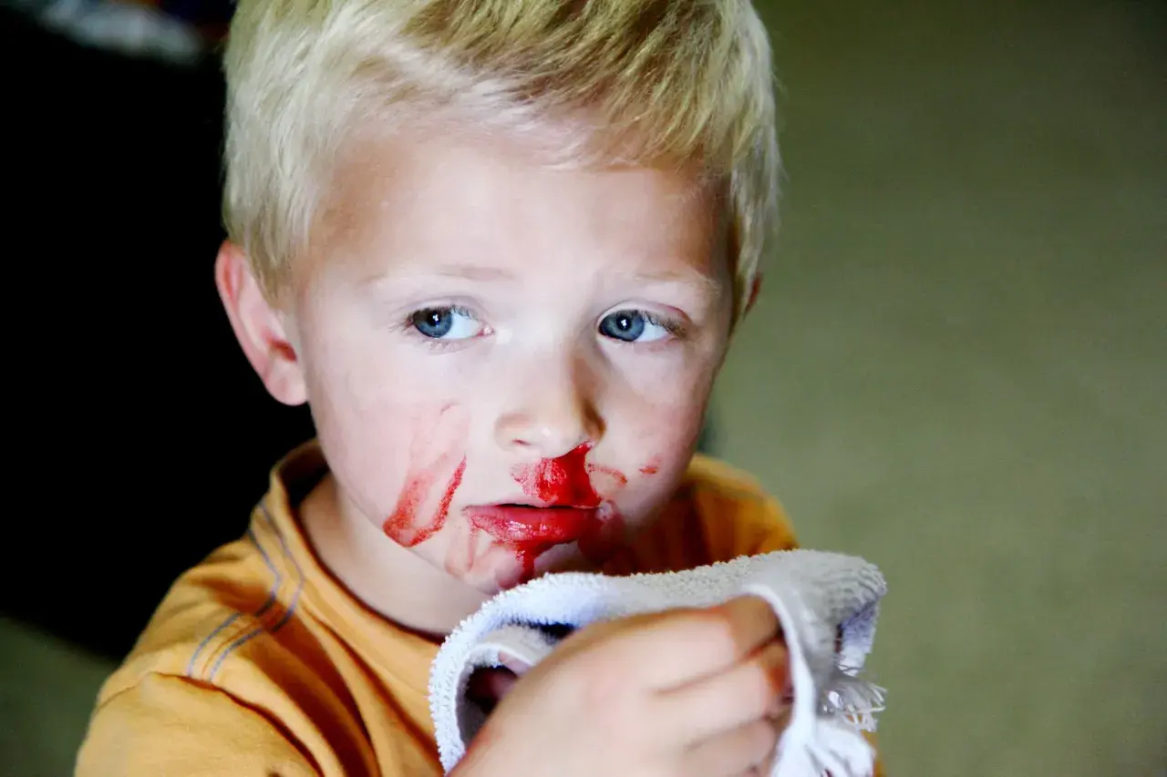 Junge mit blutiger Nase und einem Tuch. Ein häufiges Problem bei Kindern ist nasenbluten.