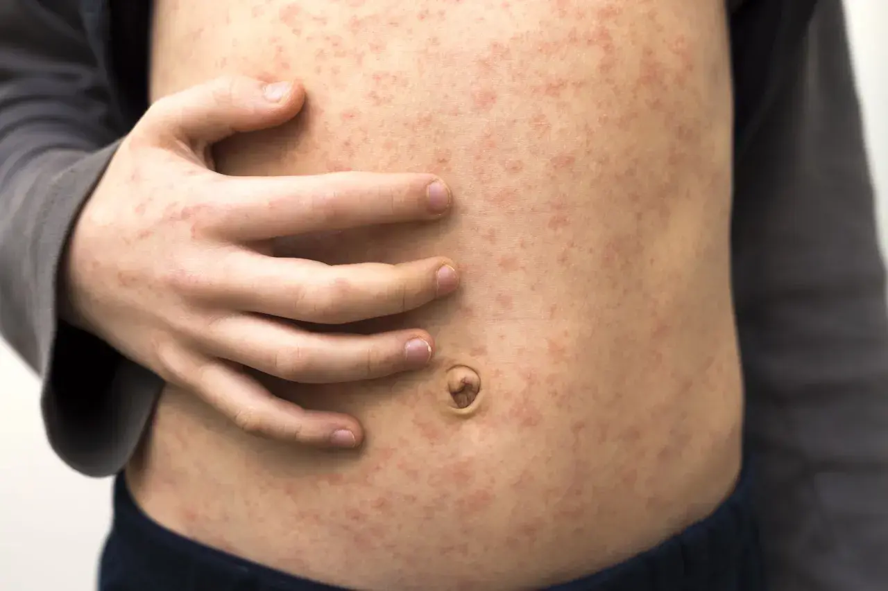 Bauch eines Kindes mit vielen kleinen roten Punkten auf der Haut, die auf eine Hautirritation oder Krankheit hindeuten.
