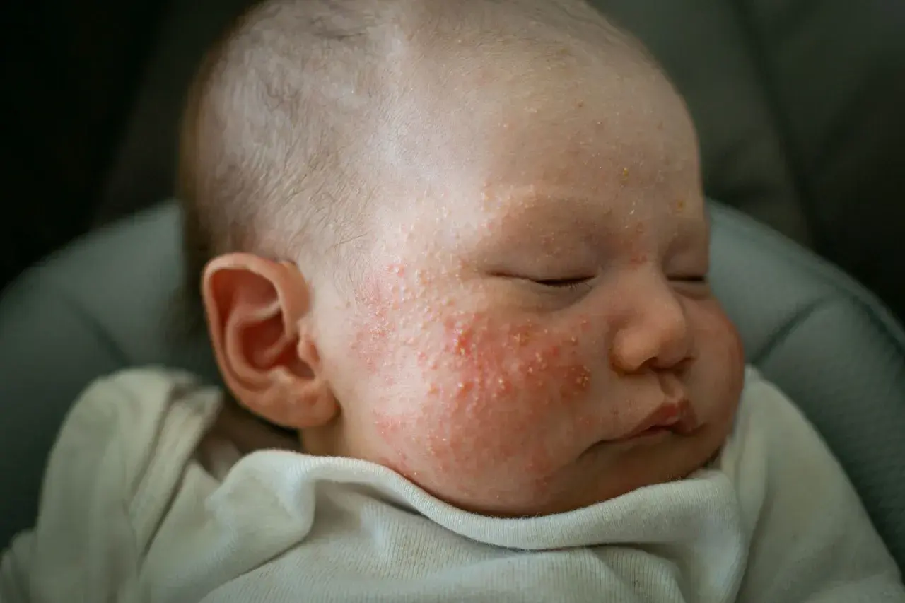 Schlafendes Baby mit geröteten Pusteln im Gesicht. Die Frage "babyakne wie lange" beschäftigt viele Eltern.