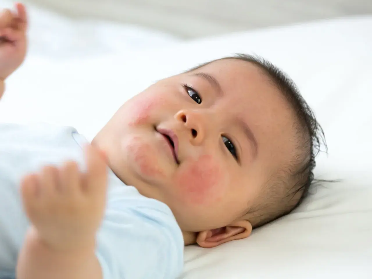 Ein Baby mit roten Flecken im Gesicht, die auf Nesselsucht bei Kindern hindeuten.