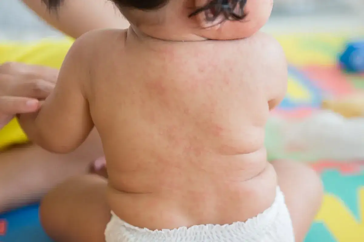 Roter Ausschlag auf dem Rücken eines Babys, deutet auf Fieber und Ausschlag bei Kindern hin.