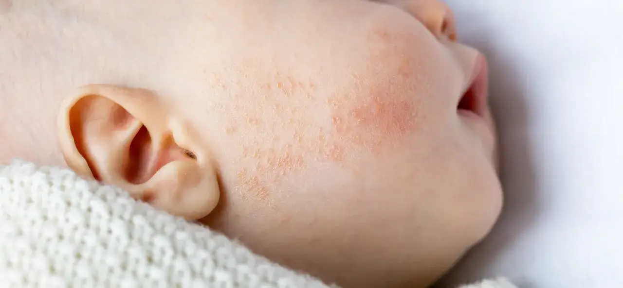 Nahaufnahme eines Babys mit Babyakne. Die roten Pickelchen auf der Wange sind gut sichtbar. Babyakne wie lange sie bleibt, ist eine häufige Frage.