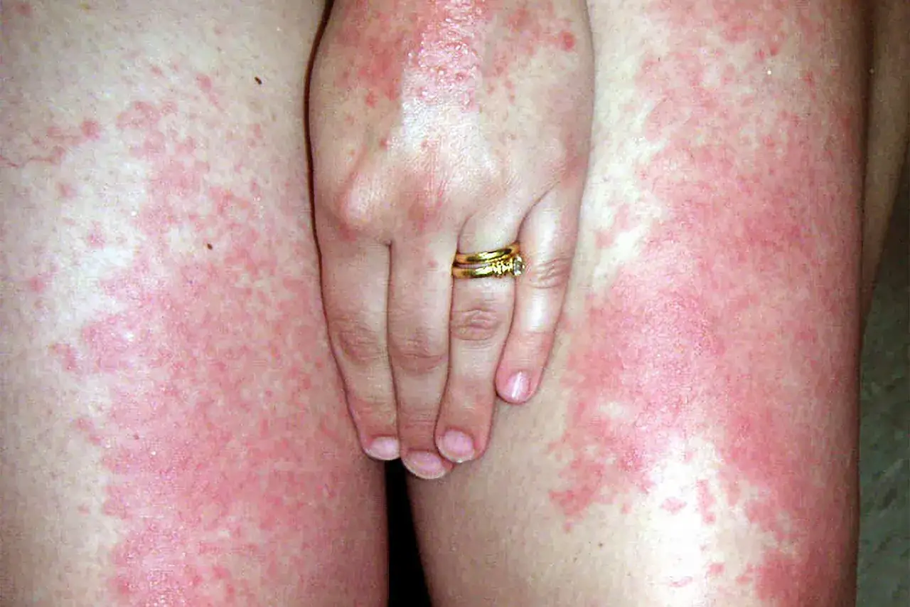 Hitzepickel und Sonnenallergie bei Kindern k&ouml;nnen sich so zeigen. Die Haut ist ger&ouml;tet und mit kleinen Pickelchen &uuml;bers&auml;t.