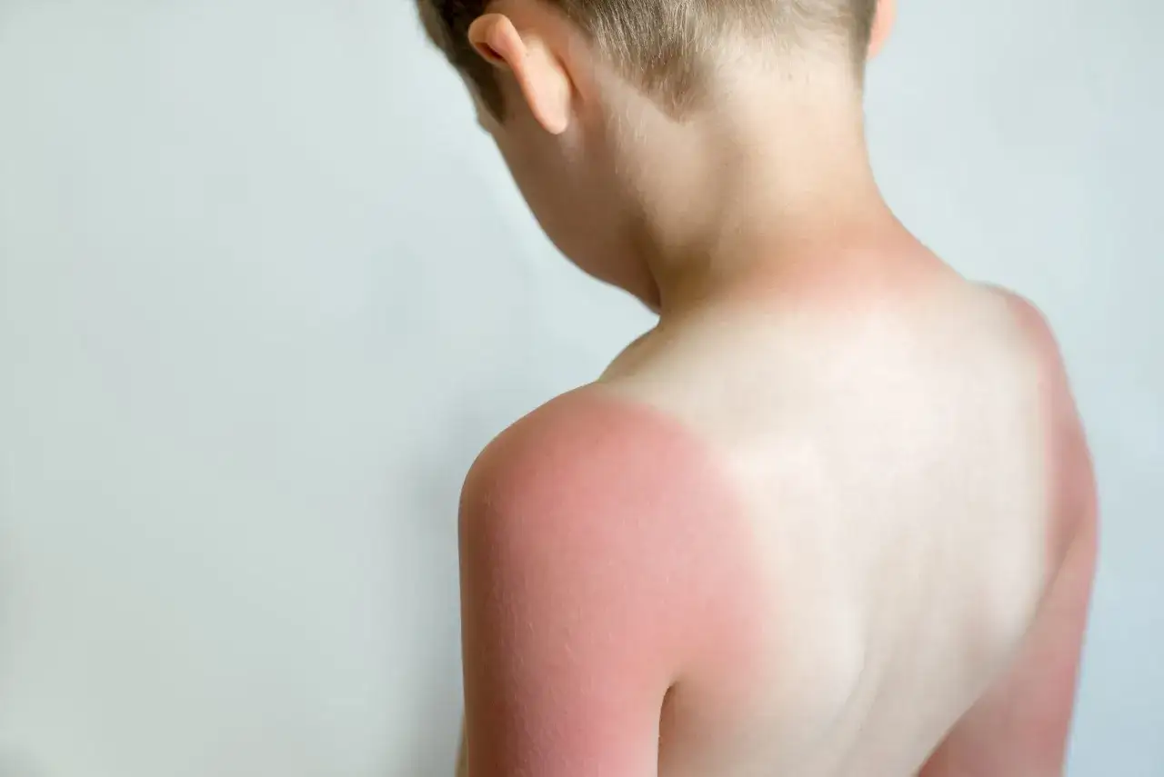 Roter Sonnenbrand auf der Schulter eines Kindes. Schnelle Hilfe mit Hausmitteln bei Sonnenbrand ist jetzt wichtig.