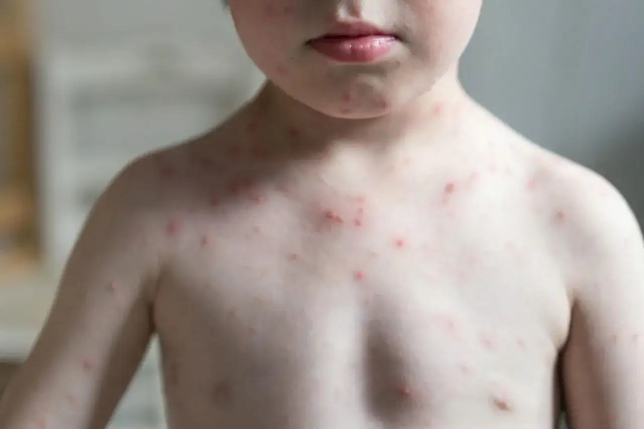 Kleiner Junge mit roten Pusteln im Gesicht und am Oberkörper. Ein typischer Hautausschlag bei Kindern, der oft Juckreiz verursacht.