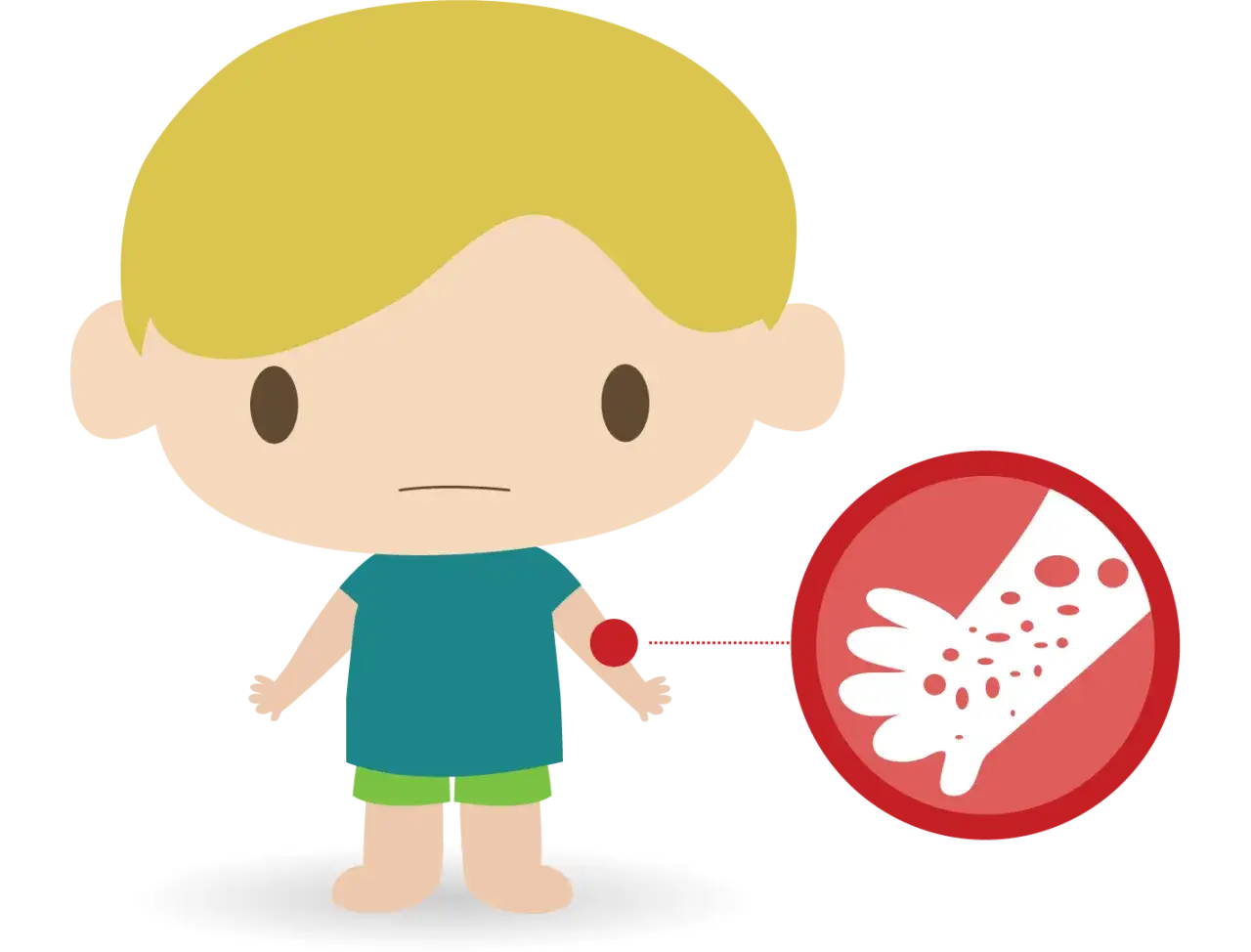 Ein Junge mit einem roten Fleck am Arm, der auf eine Hautirritation hinweist. Diese Nesselsucht-Bilder f&uuml;r Kinder zeigen typische Symptome.