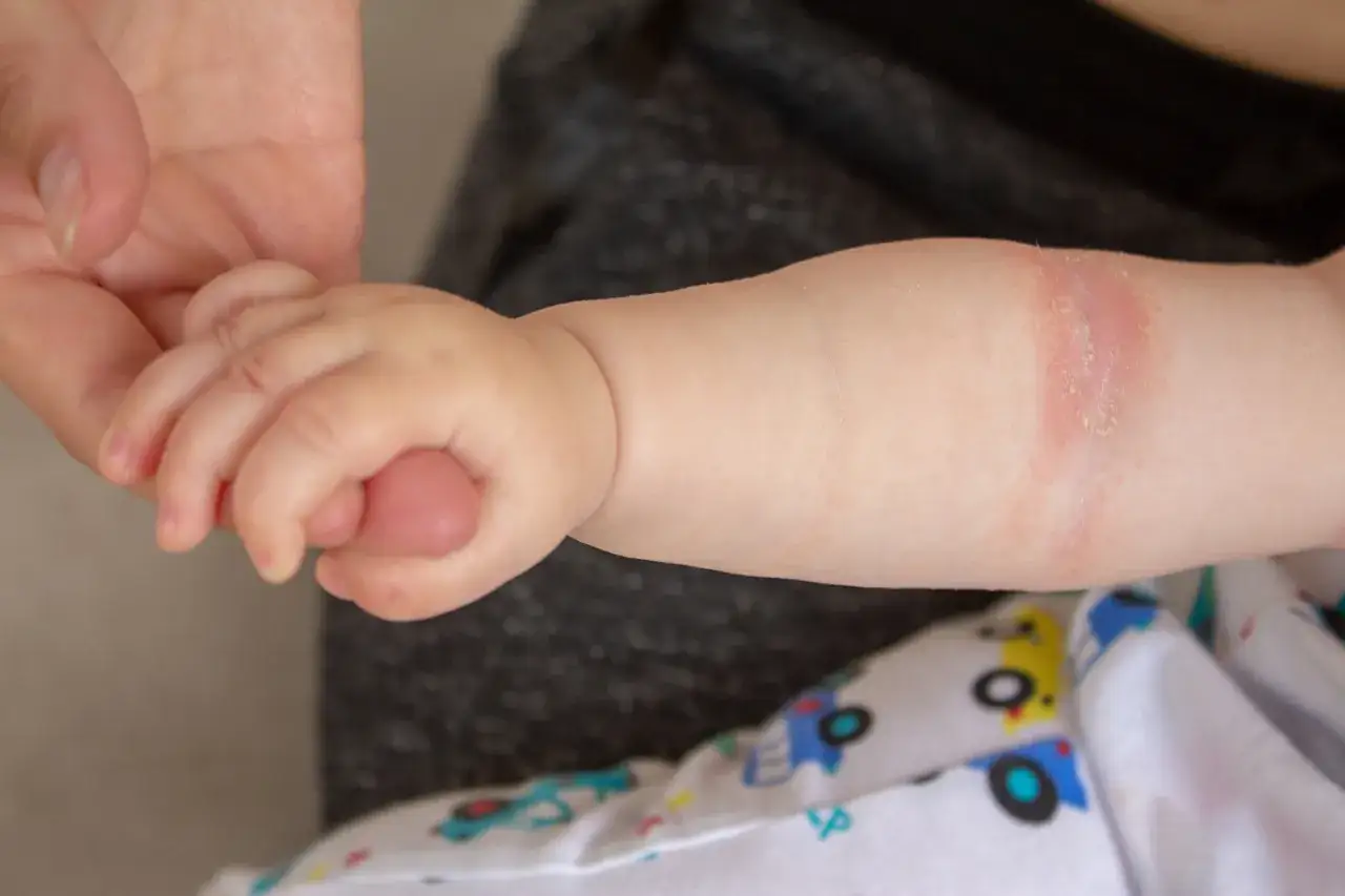 Babyarm mit ger&ouml;teter, schuppiger Stelle, die auf Windelsoor hindeutet. Vorsicht, Windelsoor ist ansteckend.