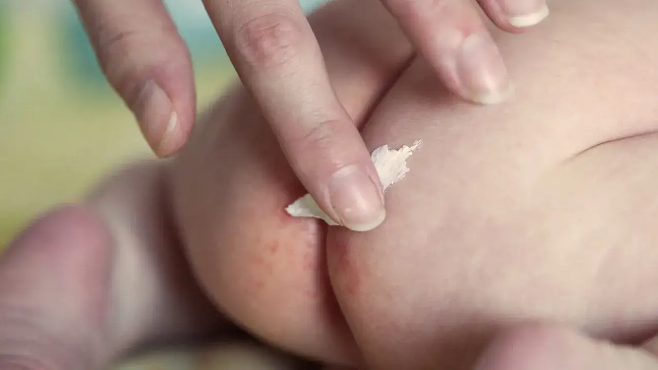 Ein Finger tr&auml;gt Salbe auf ger&ouml;tete Babyhaut auf. Schnelle Hilfe bei Windeldermatitis.