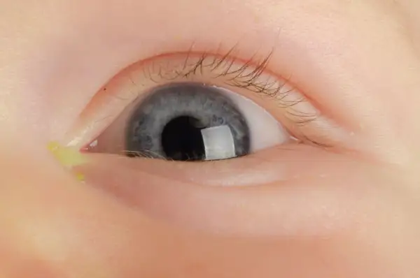 Nahaufnahme eines Babys mit einem verklebten Auge, das gelblichen Ausfluss zeigt.
