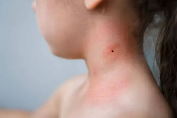 Zecke am Hals eines Kindes, gerötete Haut. Mögliche Borreliose Symptome bei Kindern früh erkennen.