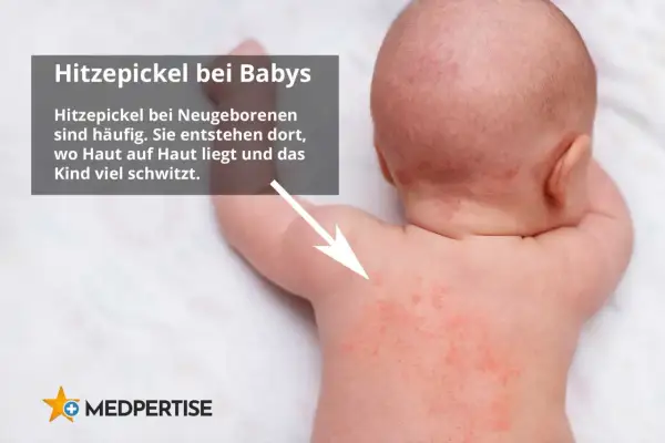 Rote Pusteln auf dem Rücken eines Babys, die auf Hitzepickel oder Sonnenallergie bei Kindern hindeuten.