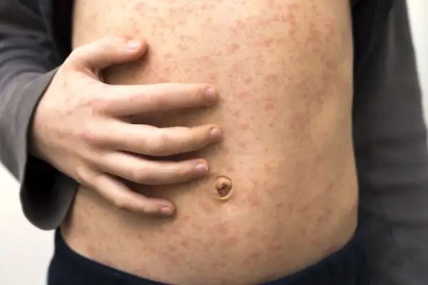 Bauch eines Kindes mit vielen kleinen roten Punkten auf der Haut, die auf eine Hautirritation oder Krankheit hindeuten.